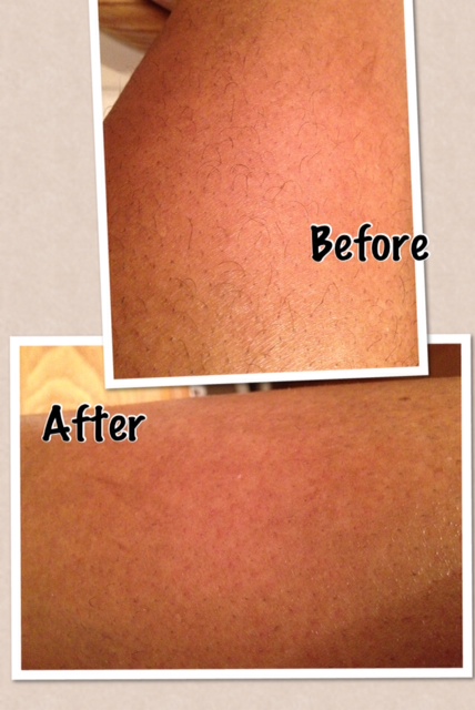 Before and After Hot Legs Hair Removal